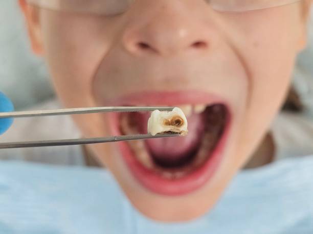 Best Emergency Tooth Extraction in Sandy Springs, SC